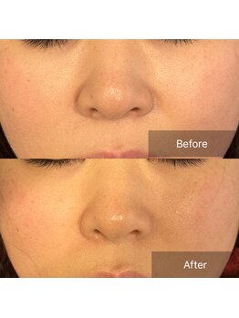 プライミー(PRIMY)/ほうれい線