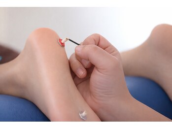 八街オアシス整骨院/お身体が弱っている時にお灸