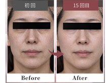 フルリール/【メソポレーションケア】