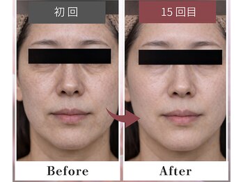 フルリール/【メソポレーションケア】