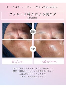 スウィートオリーブ 春日部(SweetOlive)/スーパー美容液プラセンタ