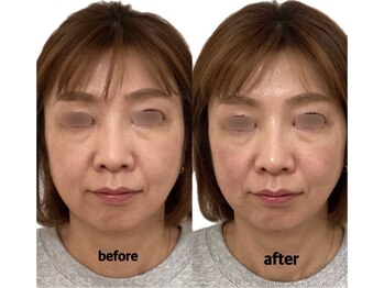 けいのき鍼灸整骨院/美容鍼1回の効果！小顔/小顔矯正