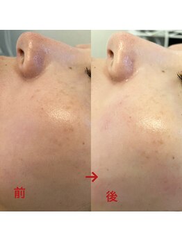 ハズキ(HAZUKI)/ハーブピーリングで悩み改善