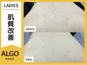アルゴ 福井店(ALGO)/脱毛だけじゃない！