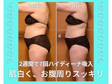 ヨサパーク フラネ(YOSA PARK Flaner)の雰囲気（大人気！水素まみれコースでこんなに変われます）