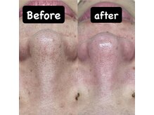 チル(Chill)/【毛穴ダイエット】