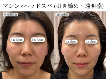 ラエッセ(La Esse)/小顔マシン×ヘッドスパ