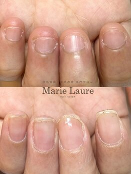 マリーロール 梅田店(Marie Laure)/自爪育成/深爪矯正/ネイルケア