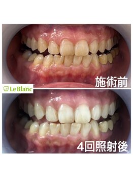 ルブラン 奈良店(Le Blanc)/15分照射4回!