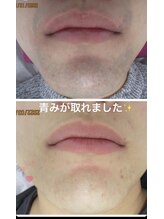 美容脱毛専門サロン エピラージュ 新宿店(Epilage)/青髭もお任せ！