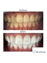 NAホワイトニング 自由が丘店/【before/after】