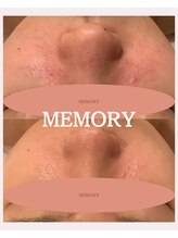 メモリー(MEMORY)/ニキビ、毛穴が改善し別人の肌に
