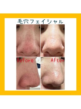 モマ(moma)/フェイシャル　毛穴ケア
