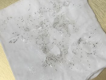 美容脱毛専門サロン エピラージュ 新宿店(Epilage)/照射後その場で抜けたヒゲです！