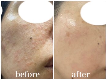 ルー ハナレ 神戸岡本 摂津本山店(Luu HANARE)/小顔　毛穴改善　肌荒れ改善