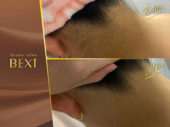 ベクスト(BEXT)/うなじ脱毛(PRO)