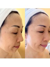 ミエル(miel)/美白パック/ホワイトニング