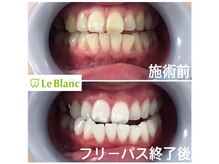 ルブラン 奈良店(Le Blanc)/必ず映える白い歯！！
