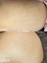 プラウディア(PROUDIA)/背中/ボディハーブピーリング