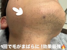 星空脱毛の雰囲気（せっかく通うなら最強効果の星空脱毛！）