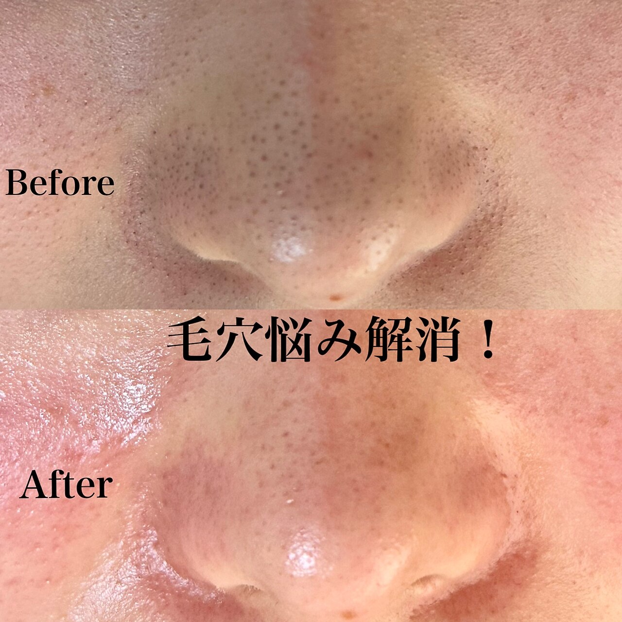 佐賀県で毛穴洗浄・毛穴吸引が人気のエステサロン｜ホットペッパー