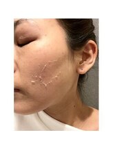 エミルカ 鹿児島店(EMILUCA)/ハーブピーリング　顔　