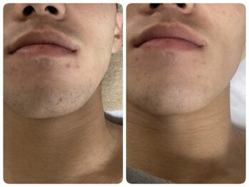 クリア 尾張旭店(Clear)/【Clear脱毛ビフォーアフター】