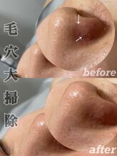アムリリー 南草津店(AMRILY)/毛穴のお悩みはお任せください
