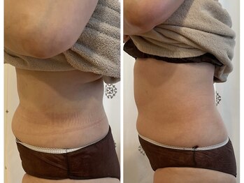 小顔アンドエイジングケア専門店 ビゼ(美sser)/REVIスカルプト6回