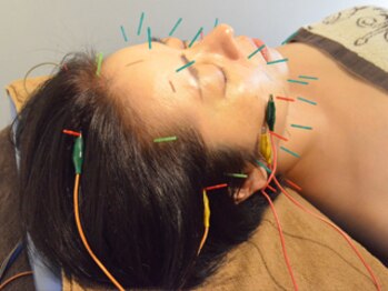 中国鍼灸院 はこしま医針堂/リフトアップ電気美容鍼