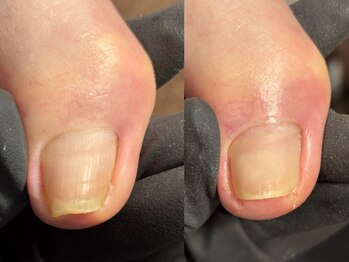 巻き爪緩和メンテナンス