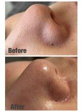 シェノン(Chainon)/フェイシャル毛穴ケア