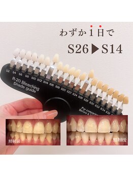 ブリエ(BRILLER)/《医》高効果ホワイトニング症例