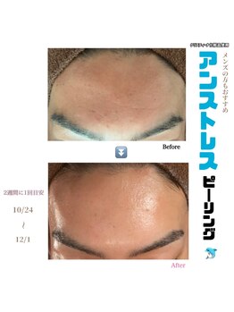 アイリス(AIRIS)/毛穴洗浄/ニキビケア/シミケア