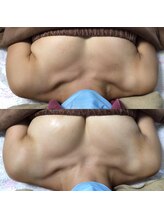 マイントゥー(mine too)/バストアップ症例