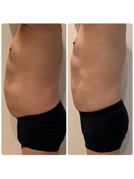 ベイジョ デ アンジョ(Beijo de anjo)/テスラシェイプ