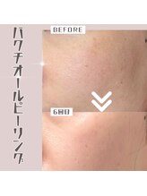 ザ エステティック福岡/バクチオールピーリング