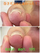 巻き爪じゅん 船橋店/巻き爪１回で変化します！