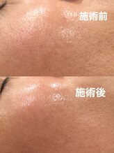 ツール(TOOL)/プラズマシャワー