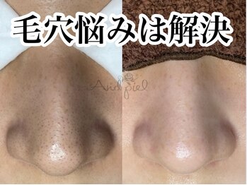 アンドピエル(AndPiel)/毛穴詰まりもすっきり綺麗に☆