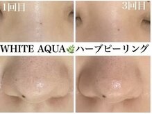 ホワイトアクア 四日市店(WHITE AQUA)/毛穴改善四日市ハーブピーリング