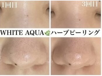 ホワイトアクア 四日市店(WHITE AQUA)/毛穴改善四日市ハーブピーリング