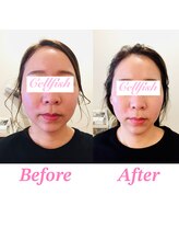 セルフィッシュ(Cellfish)/お顔のムクミたるみにアプローチ