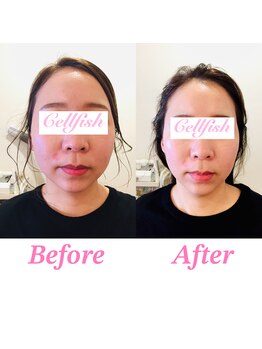 セルフィッシュ(Cellfish)/お顔のムクミたるみにアプローチ