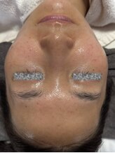 リアスキン(Lia skin)/ニキビでお悩みの方