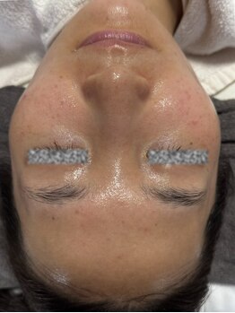 リアスキン(Lia skin)/ニキビでお悩みの方