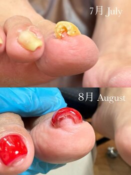 ネイルズ バイ ユイ 外苑前(Nails by Yui)/巻き爪ケアジェル 1ヶ月の変化