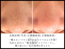 韓国肌管理室 ソア(soa)/【毛穴管理】