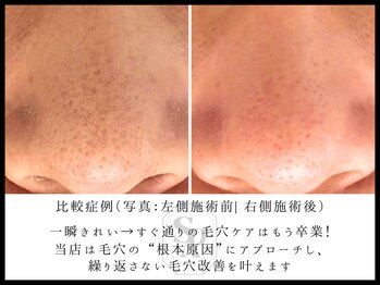 韓国肌管理室 ソア(soa)/【毛穴管理】