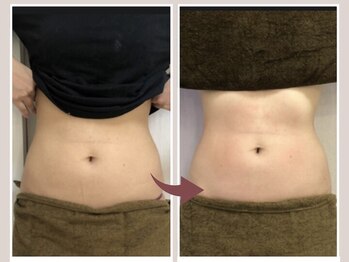 GRACETHOUSAND(グレイスサウザンド)/痩身エステ/ポッコリお腹/くびれ